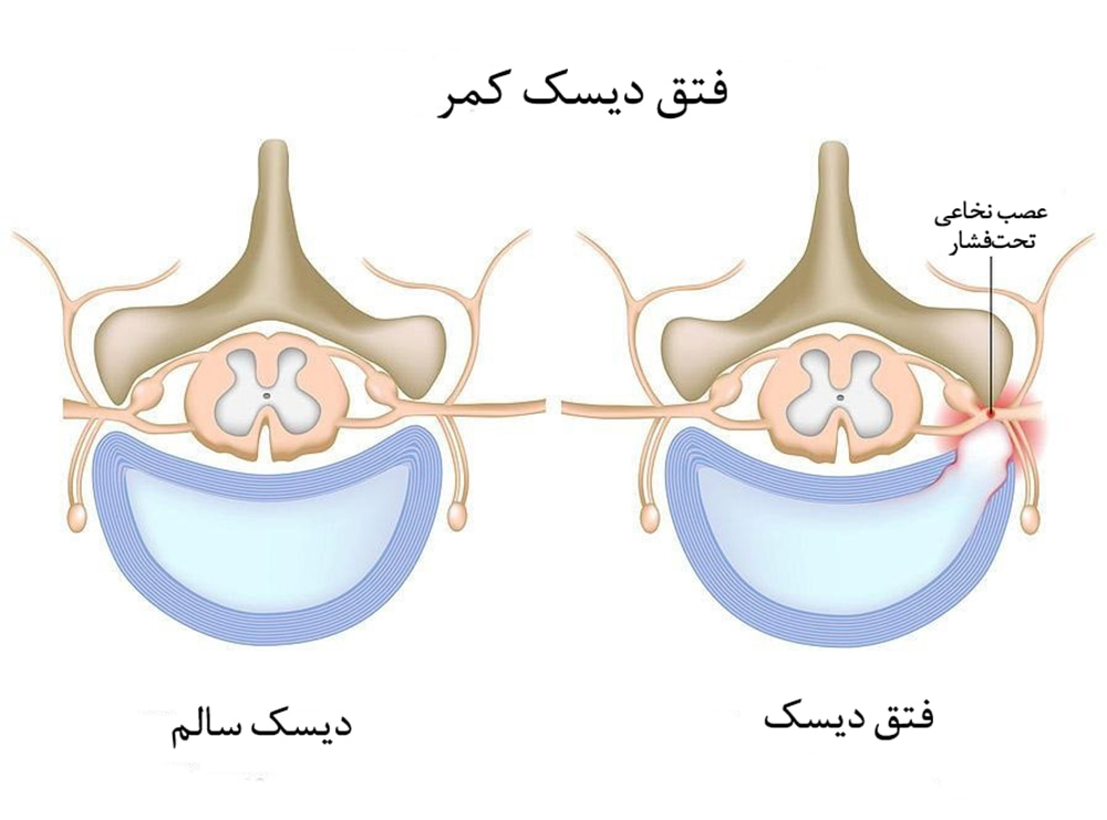 دیسک کمر، فتق دیسک، یا بیرون‌زدگی دیسک کمر چیست؟