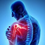 آرتروز شانه درمان خشکی و التهاب شانه بعلت آرتروز با فیزیوتراپی