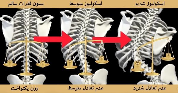 انواع اسکولیوز