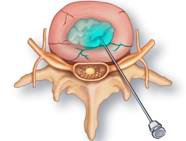 تحت فشار قرار دادن دیسک‌ها در قسمت تشخیصی عمل دیسکوگرام