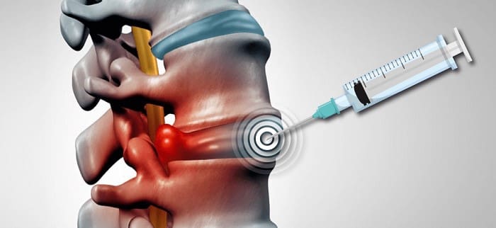 تزریق استروئید برای کاهش درد، التهاب و تورم ماهیچه، مفصل و تاندون