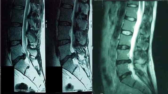 تشخیص فتق دیسک کمر
