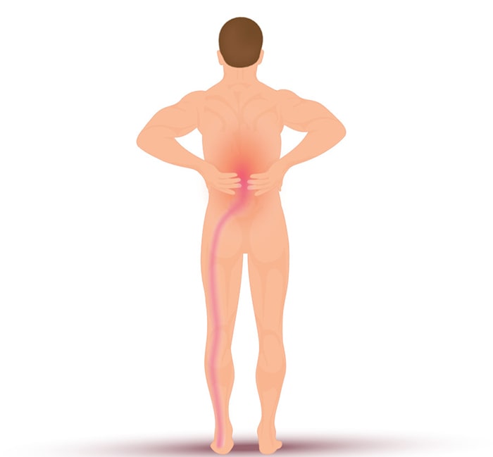 تشخیص و درمان پلکانی درد عصب سیاتیک کمر و پا با دارو و فیزیوتراپی-