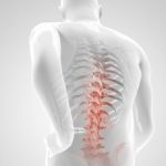 درمان آرتروز کمر و ستون فقرات با فیزیوتراپی و ورزش