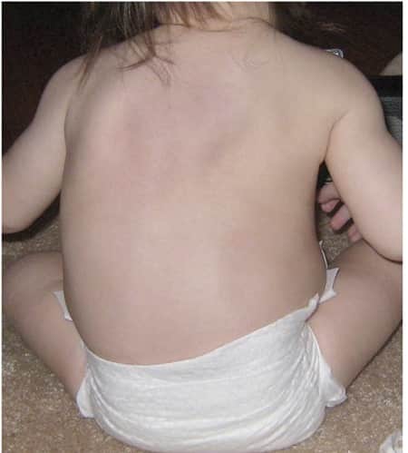 درمان انحراف ستون فقرات (اسکولیوز) در کودکان