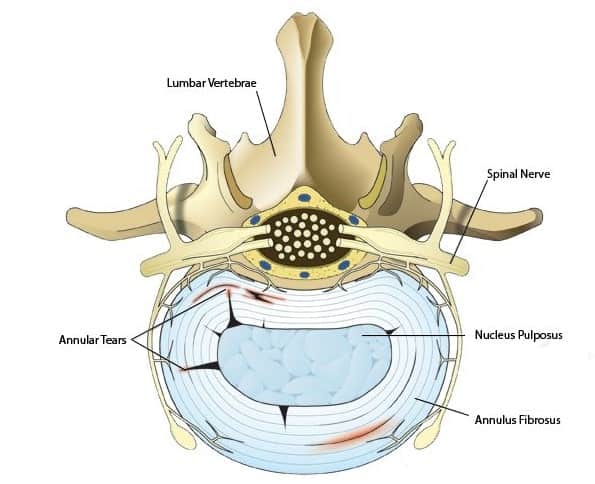 درمان سرخوردگی مهره های کمر