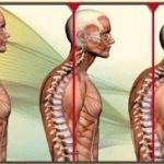 درمان عارضه سر و گردن به جلو با ورزش و حرکات اصلاحی