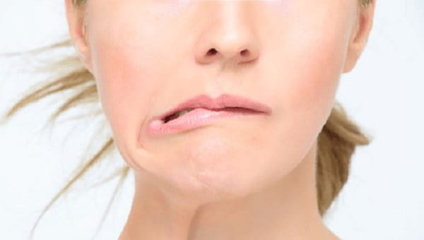 درمان فلج بلز با فیزیوتراپی