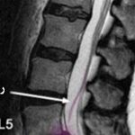 دیسک بین مهره‌ای S1-L5