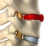 دیسک بین مهره‌ای علائم و درمان