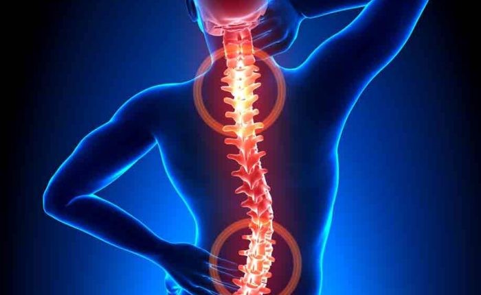 دیسک توراسیک چیست و چگونه درمان میشود؟ (فیزیوتراپی توراسیک)