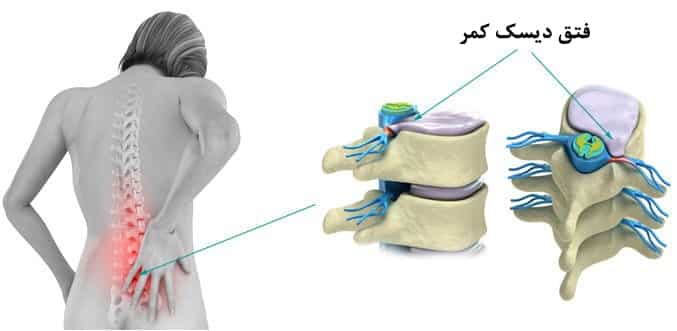 دیسک کمر