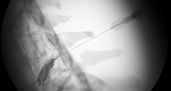 روش بلوک انتخابی ریشه عصب دیسک گردن