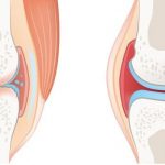 روماتیسم مفصلی (آرتریت روماتوئید) دست و پا چه علائمی دارد؟