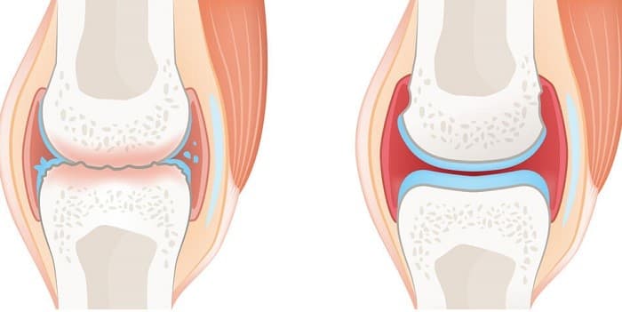 روماتیسم مفصلی (آرتریت روماتوئید) دست و پا چه علائمی دارد؟