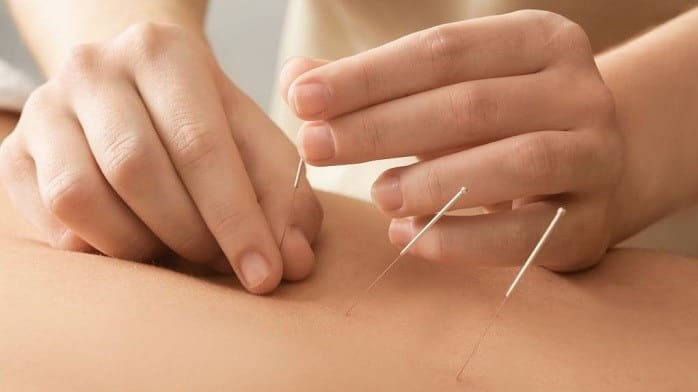 درمان گردن درد عصبی با طب سوزنی