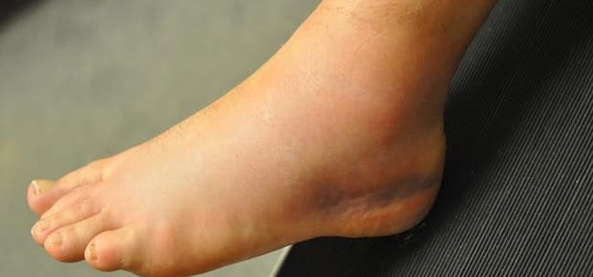 علائم پیچ خوردگی مچ پا