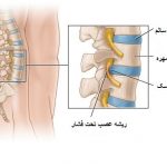 علایم دیسک کمر و درمان بدون جراحی