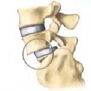 علت سرخوردگی مهره های کمر