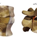 علت و درمان سرخوردگی، لغزش و جا به جایی مهره های کمر
