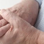 عوامل ایجاد خواب رفتگی و گزگز دست و تشخیص با نوار عصب و عضله