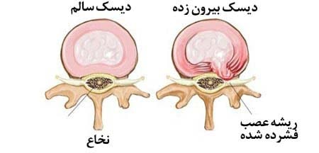 فتق دیسک کمر چیست