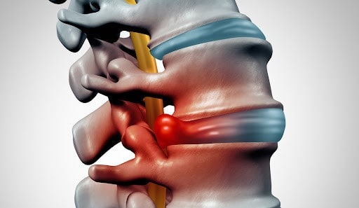 پیشگیری از فتق دیسک