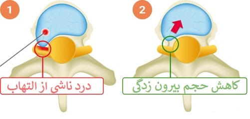 کاهش فشار و درمان دیسک با استفاده از لیزر